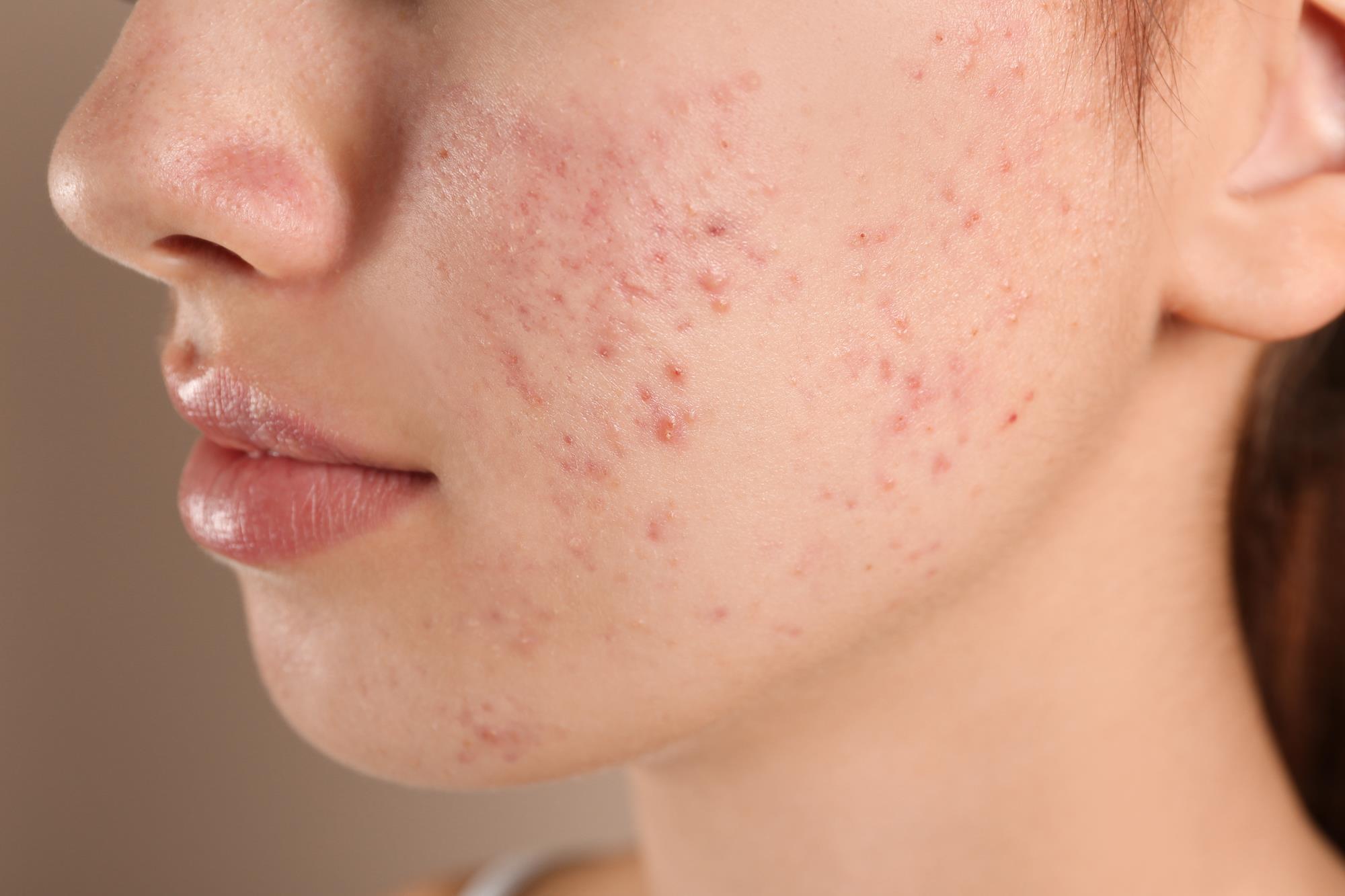 Before Acne Treatment